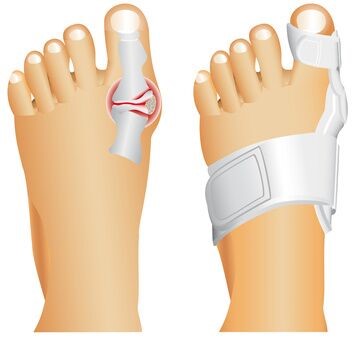 Bunion Taping and Splint