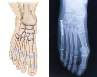 Jones fracture treatment and surgery