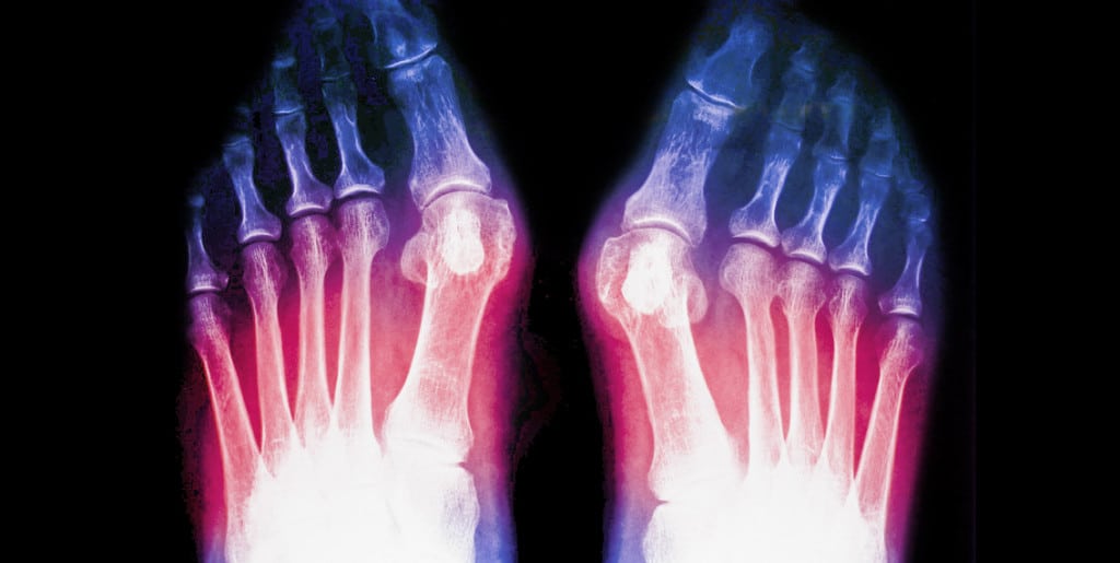 Jones fracture treatment and recovery