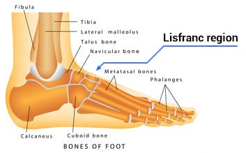 Lisfranc Injury