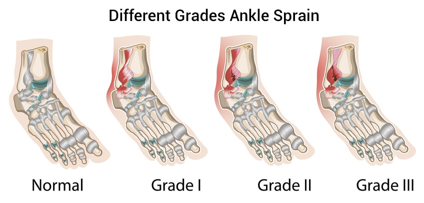Types and Grades of Ankle Sprains 