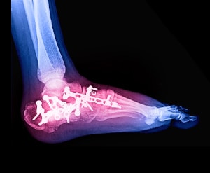 Foot pain diagram