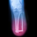 below knee amputee x-ray image