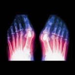 jones fracture x-ray image