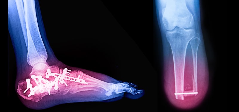 Below knee amputation x-ray image
