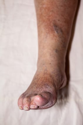 Swollen leg before amputation image