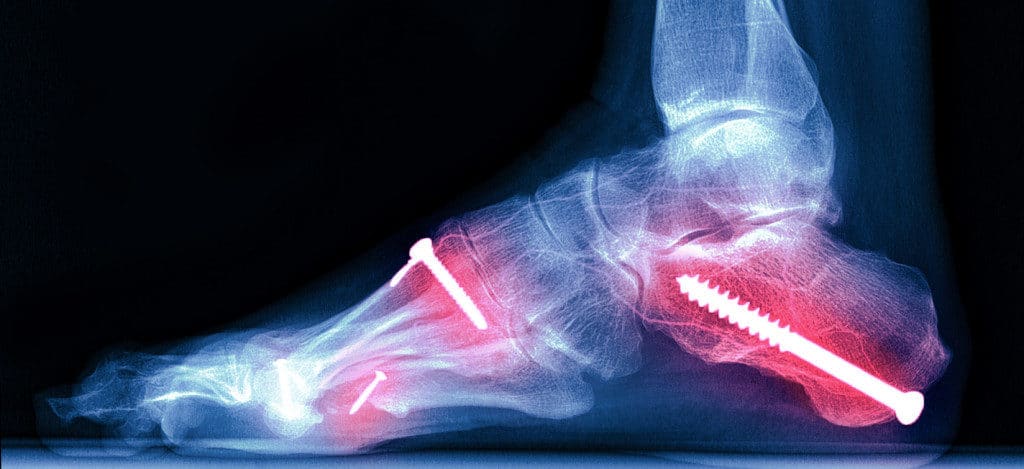 Ankle sprain: MedlinePlus Medical Encyclopedia Image