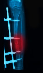 leg x-rays image showing plate and screw external fixation tibia iWALK Hands-Free Crutch