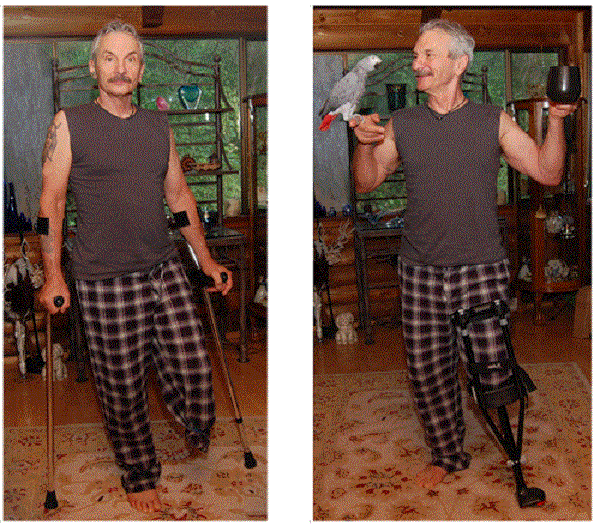 Man wearing iWALK Hands-Free Crutch vs wearing forearm crutches