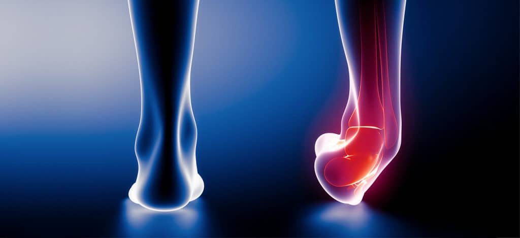 Sprained Ankle: Diagnosis, Treatment, & Recovery