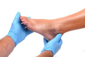 image of an ankle bruise