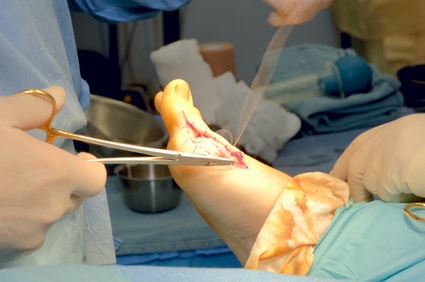 foot surgery photo on bunion 