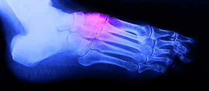 Stress fracture x-ray