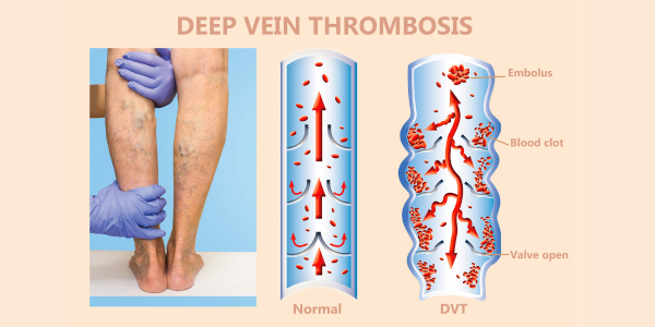 Deep Vein Thrombosis Infographic